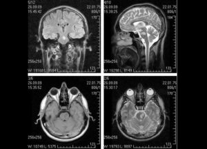 снимок КТ головного мозга