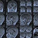 МРТ и КТ головного мозга: какую из процедур выбрать?