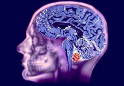 Для чего необходимо МРА исследование головного мозга?